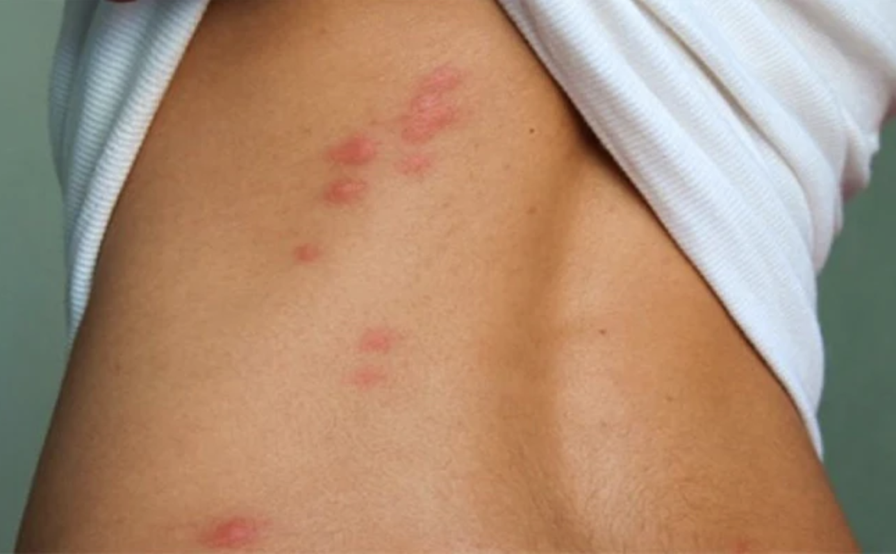 Typical bedbug bite patterns on human skin.